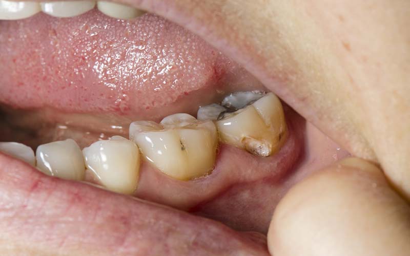 راهكارهای جلوگیری از پوسیدگی دندان ها