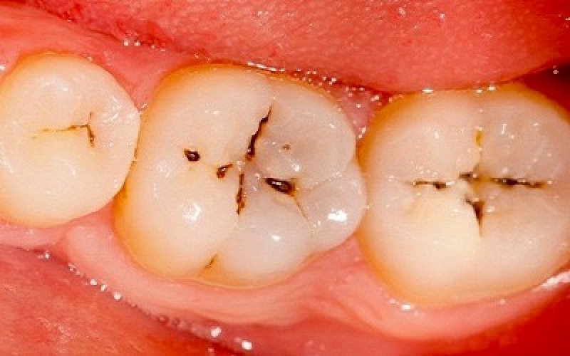 علائم و مراحل پوسیدگی دندان