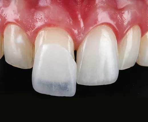 چه عواملی بر تغییر رنگ روكش دندان موثر است