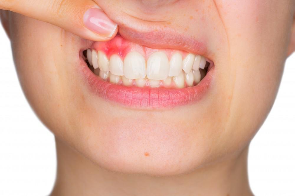 چه زمانی به جراحی لثه نیاز پیدا می کنیم؟ | زمان جراحی لثه ؟