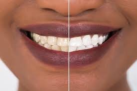 قیمت سفید کردن دندان چقدر است؟ | هزینه سفید کردن دندان ها 