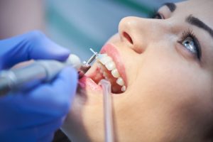 آیا جرمگیری برای دندان ضرر دارد؟