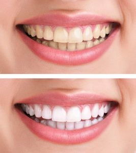 قیمت سفید کردن دندان چقدر است؟ | هزینه سفید کردن دندان ها 