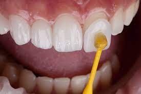 همه چیز در مورد لمینت دندان | لمینت دندان چگونه انجام می شود