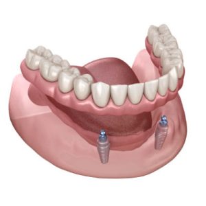 پروتزهای متحرک و ثابت دندان چیست و چه کاربردی دارد؟