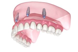 پرتزهای متحرک دندان چیست و چه کاربردی دارد