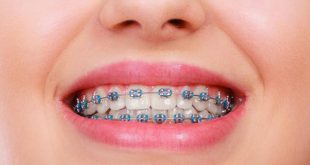 قیمت ارتودنسی دندان چقدر است؟ | هزینه ارتودنسی با بیمه چقدر است