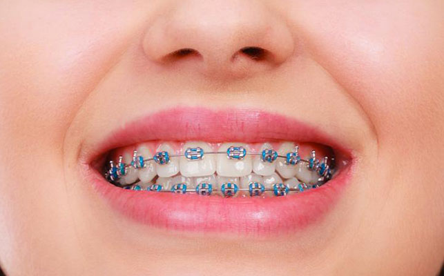 قیمت ارتودنسی دندان چقدر است؟ | هزینه ارتودنسی با بیمه چقدر است