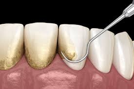 مزایای جرم گیری دندان چیست؟ | آیا جرم گیری دندان ها را سفید می کند