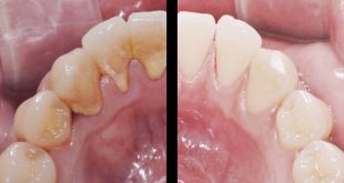 مزایای جرم گیری دندان چیست؟