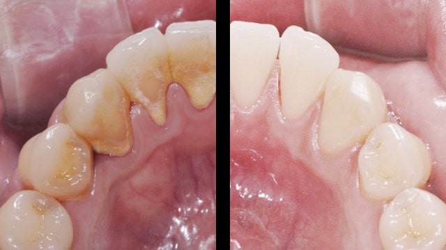 مزایای جرم گیری دندان چیست؟ | آیا جرم گیری دندان ها را سفید می کند
