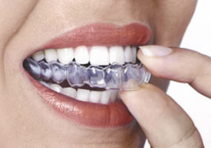 دندان قروچه چه تاثیری بر دندان ها می گذارد؟ | علت دندان قروچه چیست؟