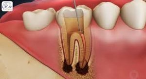 مراحل عصب کشی دندان 