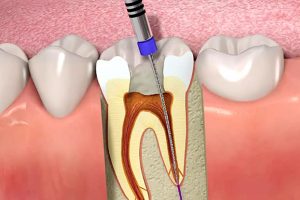 مراحل عصب کشی دندان 