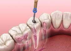 هزینه عصب کشی دندان چقدر است؟