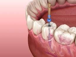 هزینه عصب کشی دندان چقدر است؟ | قیمت عصب کشی دندان و پر کردن