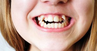 نهفتگی دندان و درمان آن | روش درمان بدون درد نهفتگی دندان ها
