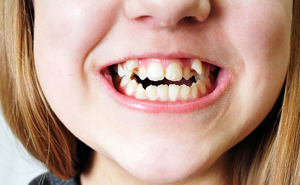 نهفتگی دندان و درمان آن | روش درمان بدون درد نهفتگی دندان ها
