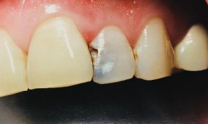 روش های جلوگیری از پوسیدگی دندان | علت پوسیدگی دندان چیست؟