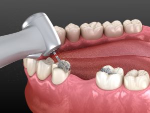 کامپوزیت دندان چگونه انجام می شود؟ | کامپوزیت چگونه انجام می شود
