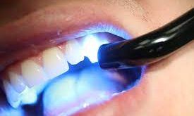 کامپوزیت دندان چگونه انجام می شود؟ | کامپوزیت چگونه انجام می شود