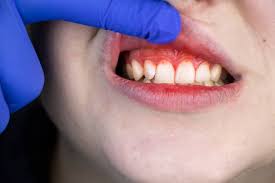 آیا دندان آبسه کرده را می توان عصب کشی کرد؟ | کلینیک تخصصی ژنیک