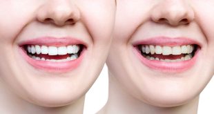 تفاوت بلیچینگ دندان با جرم گیری دندان چیست؟