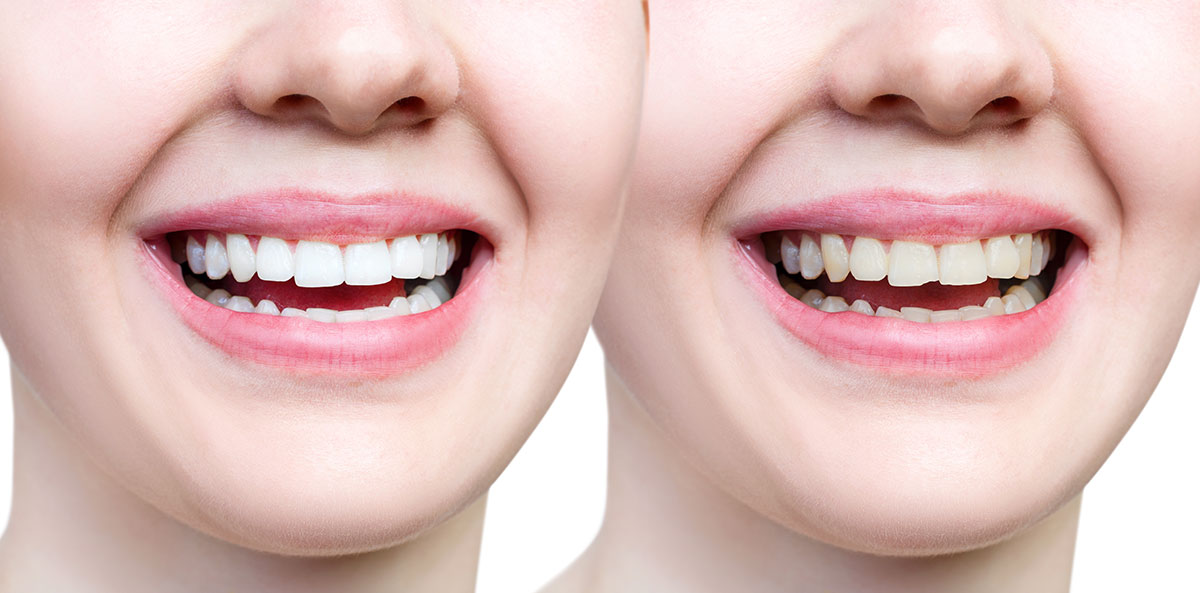 تفاوت بلیچینگ دندان با جرم گیری دندان چیست؟ | کلینیک تخصصی ژنیک