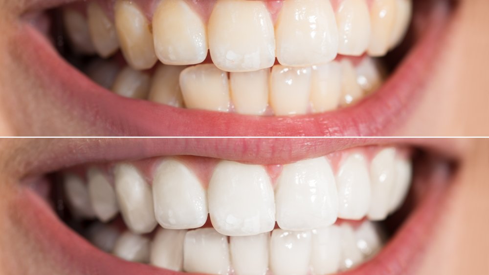 تفاوت بلیچینگ دندان با جرم گیری دندان چیست؟ | کلینیک تخصصی ژنیک