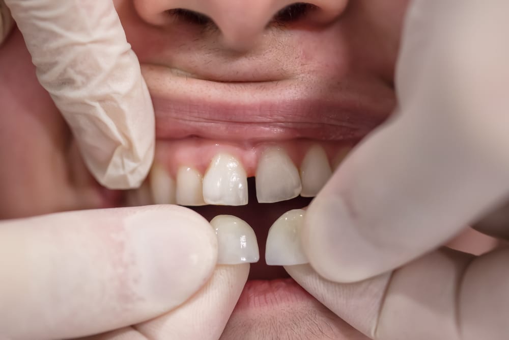 انواع روکش دندان کدامند؟ قیمت روکش دندان | کلینیک تخصصی ژنیک