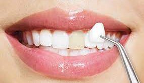 انواع روکش دندان کدامند؟