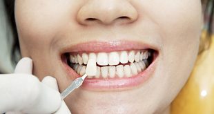 عمر لمینت دندان چقدر است؟