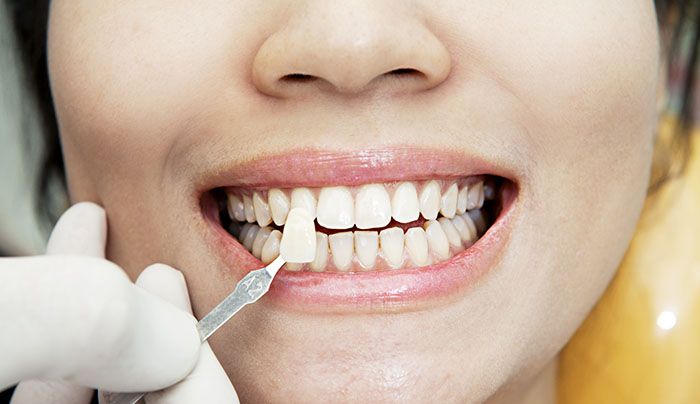 عمر لمینت دندان چقدر است؟ | لمینت فوری دندان در کلینیک ژنیک