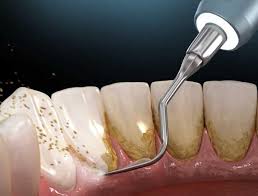 پلاک دندان چیست؟علت تشکیل پلاک دندان و راه درمان آن - ژنیک