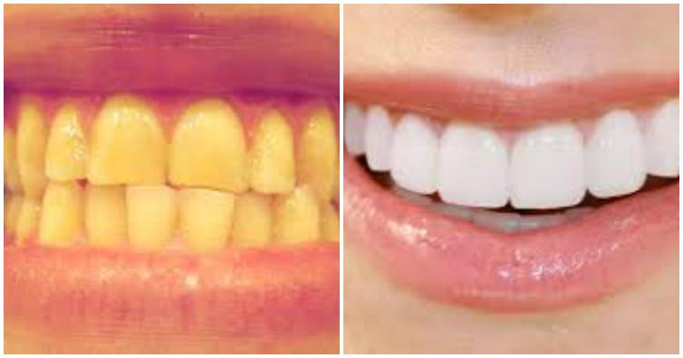 پلاک دندان چیست؟علت تشکیل پلاک دندان و راه درمان آن - ژنیک