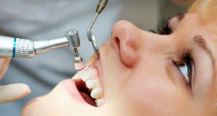 پلاک دندان چیست؟ علت تشکیل پلاک دندان و راه درمان آن