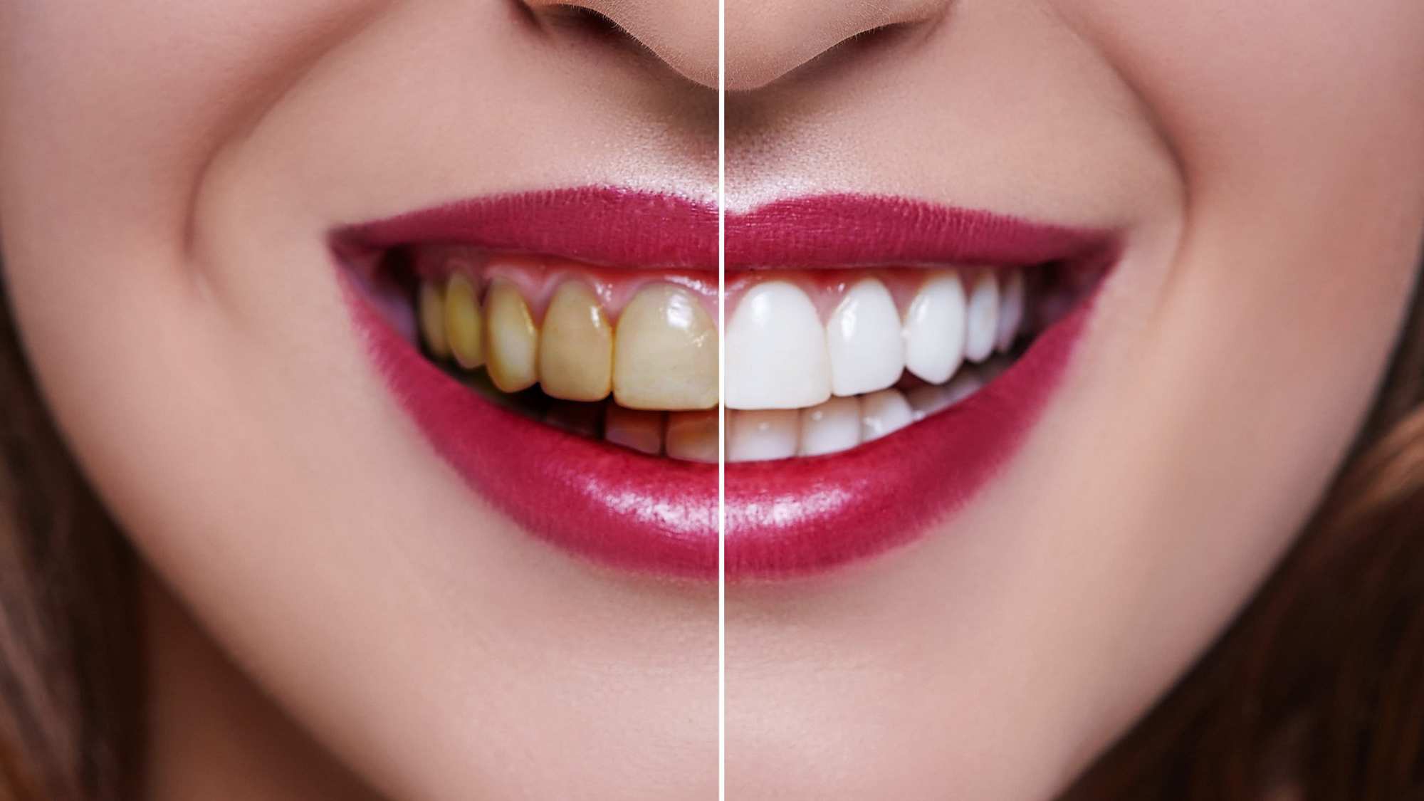 انواع روش های سفید کردن دندان | سریعترین زمان سفید کردن دندان - ژنیک
