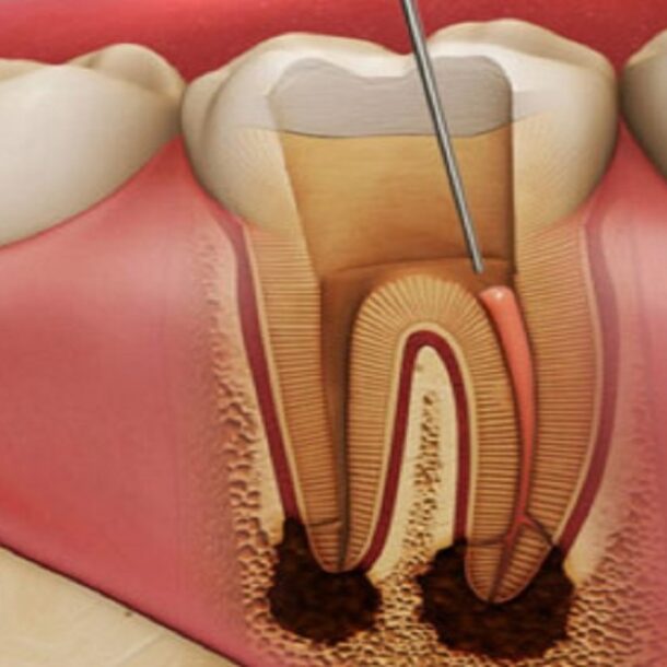 عمر دندان عصب کشی شده چقدر است؟ | مراقبت از دندان عصب کشی - ژنیک