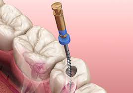 عمر دندان عصب کشی شده چقدر است؟ | مراقبت از دندان عصب کشی - ژنیک