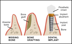 جراحی و پیوند استخوان فک | هزینه پیوند استخوان - کلینیک ژنیک