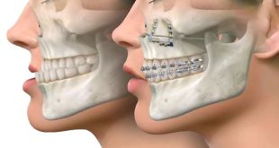 مراقب های پس از عمل جراحی دهان و فک