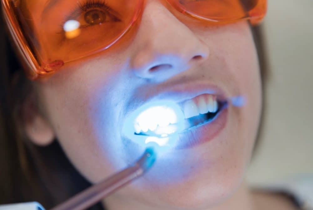 روش سفید کردن دندان با لیزر