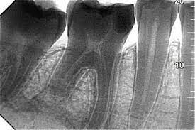 دلیل اصلی تحلیل ریشه دندان