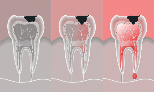 اپکسیفیکاسیون ریشه دندان