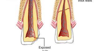 اپکسیفیکاسیون ریشه دندان