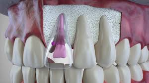 دلیل اصلی تحلیل ریشه دندان