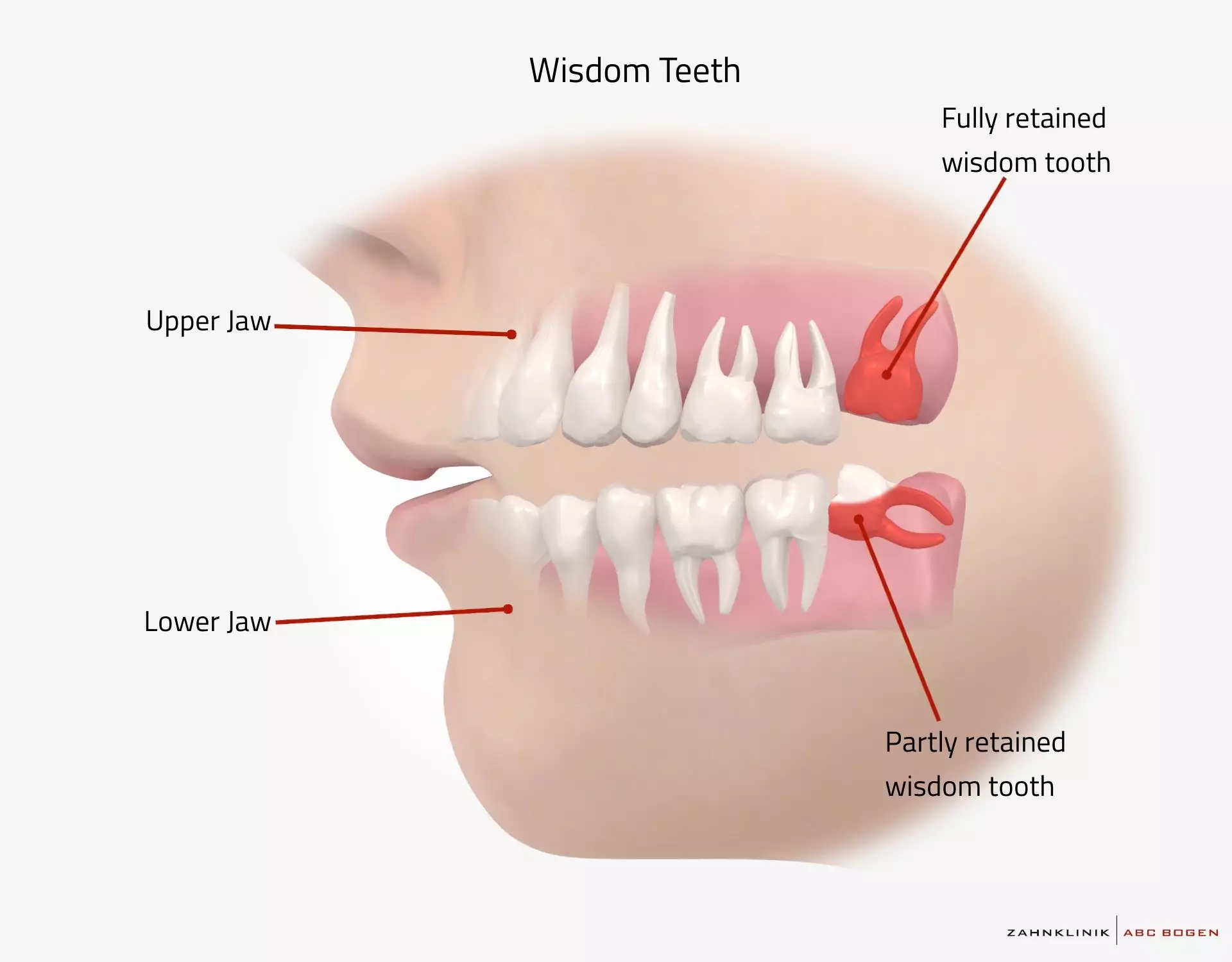 درد بعد از عصب کشی دندان