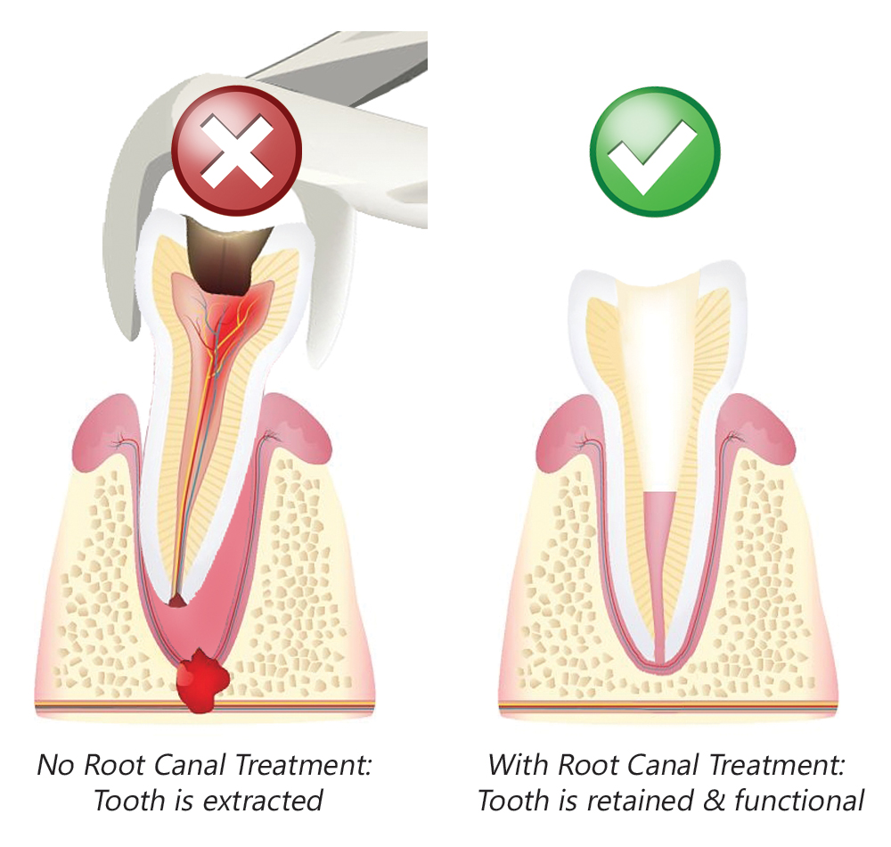 درمان ریشه دندان با روش های نوین