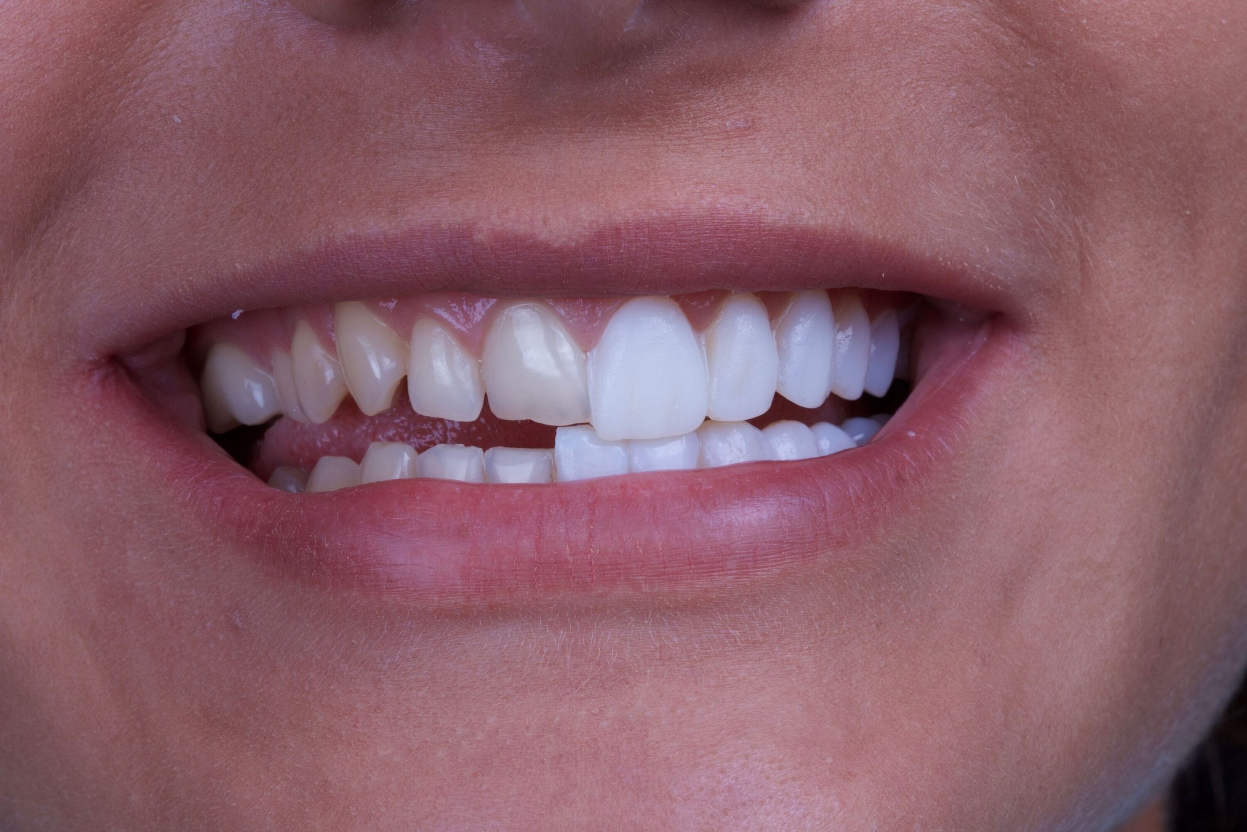 مراحل ساخت روکش دندان