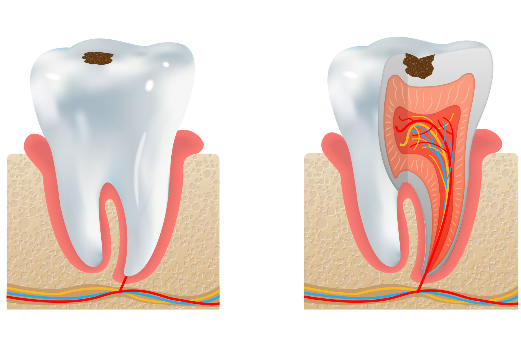 درمان ریشه دندان با سلول های بنیادی
